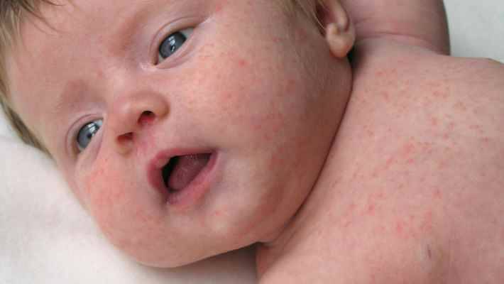 dermatite-da-contatto-bambino-neonato
